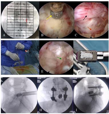 Learning Curve and Initial Outcomes of Full-Endoscopic Posterior Lumbar Interbody Fusion